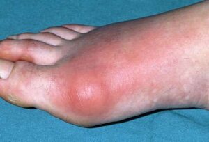 gout5